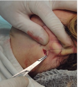 Fixação do fio mononylon. Fixação do fio de sutura no
                                        periósteo do osso mastoide. Notar que o fio do lado
                                        contralateral já foi passado e encontra-se com a ponta na
                                        parte anterior do pescoço