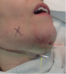 Passagem do fio. Passando a agulha de Casagrande como
                                        guia, o fio se encontra na ponta da agulha. A outra
                                        extremidade já está fixada no mastoide