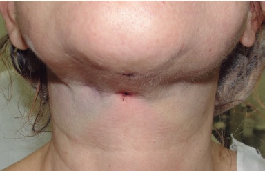 Pós-operatório imediato. Pós-operatório imediato,
                                        mostrando a sutura no local onde a agulha de Casagrande
                                        passou o fio e a sutura na prega submentoniana por onde
                                        passou a cânula de lipoaspiração