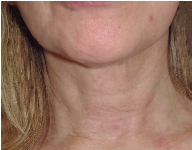 Pós-operatório tardio (1 ano). Pós-operatório tardio após 12 meses do
                            procedimento. Notar a melhora das bandas platismais, que praticamente
                            desapareceram, e o melhor contorno do rebordo mandibular