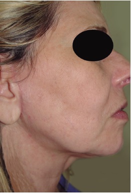 Pós-operatório tardio. Notar a melhora no contorno da mandíbula e a
                            diminuição do ângulo cérvico-mandibular devido à diminuição da ptose das
                            bandas platismais. Houve melhora global da região cervical. A cicatriz
                            pré-auricular do minilifting está quase imperceptível.
                            Pacientes com pouca redundância de pele nem necessitam de
                                minilifting associado, o que os poupa da cicatriz
                            pré-auricular