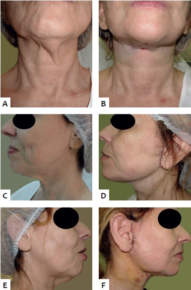 Visão frontal e perfil esquerdo e direito, antes e após o
                            procedimento. A - Pré operatório visão frontal;
                                B - Pós operatório imediato visão frontal;
                                C - Pré operatório, perfil esquerdo; D -
                            Pós operatório de sete dias, perfil esquerdo; E - Pré
                            operatório, perfil direito; F - Pós operatório de sete
                            dias, perfil direito