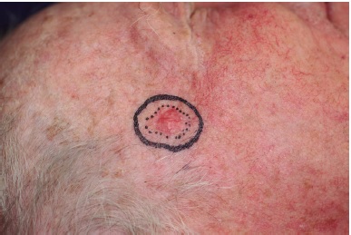 Carcinoma basocelular nodular (linhas pontilhadas) com margens
                            cir&uacute;rgicas de 5mm