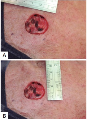 A e B - Ferida operat&oacute;ria medindo 2,7 x 2,5cm