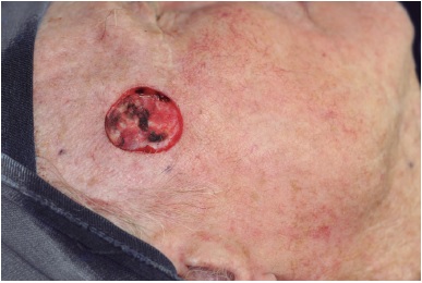 Defeito cir&uacute;rgico criado sobre o trajeto do ramo temporal do nervo
                            facial