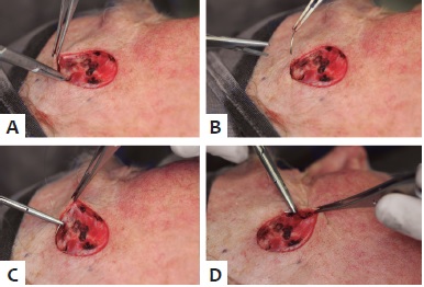 A-D: Detalhe da sutura realizada no plano
                            intrad&eacute;rmico