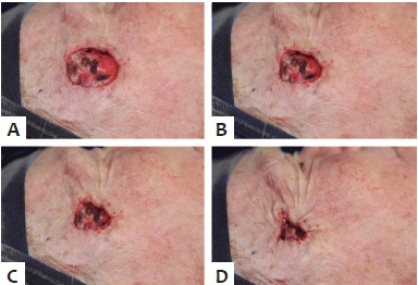 A-D - Sutura tracionada e n&oacute; sepultado
                            intrad&eacute;rmico