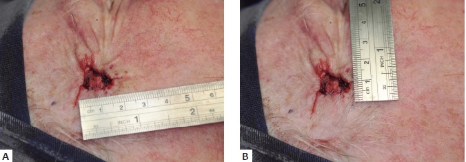 A e B - Defeito final com 1,4 x 1,1cm