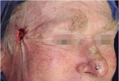 Apar&ecirc;ncia inicial do defeito parcialmente fechado e deixado
                            cicatrizar por segunda inten&ccedil;&atilde;o