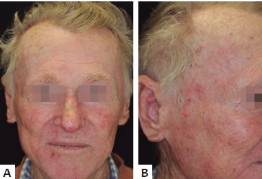 A e B - Cicatriza&ccedil;&atilde;o completa ap&oacute;s oito semanas