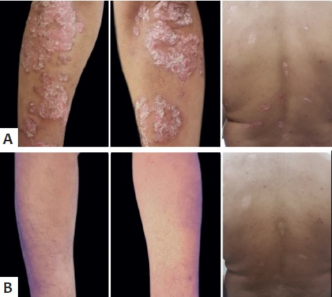 A - Pr&eacute;-tratamento: bra&ccedil;o direito, bra&ccedil;o esquerdo e
                            dorso. B - Ap&oacute;s quatro aplica&ccedil;&otilde;es de CYA por
                                MMP&reg; no bra&ccedil;o direito com melhora de ambos os
                            bra&ccedil;os e dorso