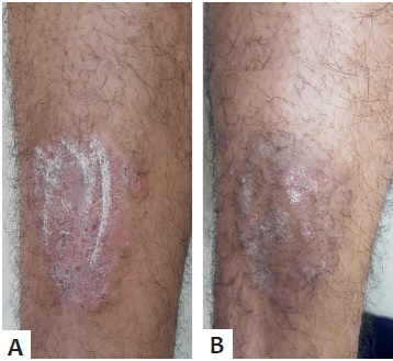 A - Antes do tratamento. B - duas semanas
                            depois de MMP&reg; com MTX