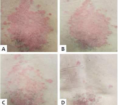 A - Pr&eacute;-tratamento; B - Ap&oacute;s uma sess&atilde;o de
                                MMP&reg; com CYA; C - Ap&oacute;s tr&ecirc;s sess&otilde;es;
                                D - Ap&oacute;s cinco sess&otilde;es