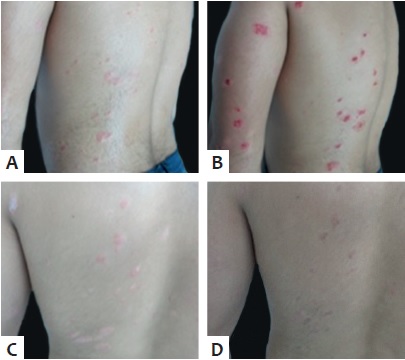 A - Les&otilde;es que receberam aplica&ccedil;&atilde;o de
                                MMP&reg; com MTX; B - Imediatamente ap&oacute;s;
                                C - Ap&oacute;s uma semana; D - Ap&oacute;s duas
                            semanas