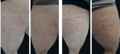 Melhora das les&otilde;es nas pernas n&atilde;o submetidas a tratamento algum em
                            paciente que recebeu MTX apenas nas les&otilde;es do dorso