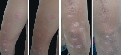 Melhora de les&otilde;es nos bra&ccedil;os n&atilde;o submetidas a tratamento algum em
                            paciente que recebeu MTX apenas nas les&otilde;es do dorso