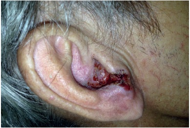 Carcinoma basocelular no pré-operatório
