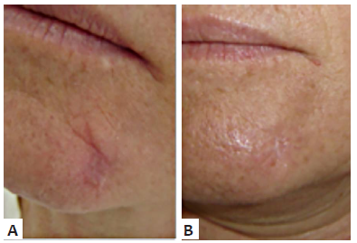 A - Cicatriz recente (exérese de carcinoma
								basocelular) B - Após cinco meses de uso de gel de
								silicone