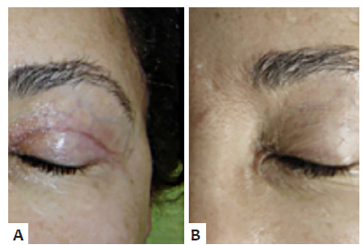 A - 10° dia de pós-operatório de blefaroplastia
								superior B - Após três meses, com uso de gel de
								silicone