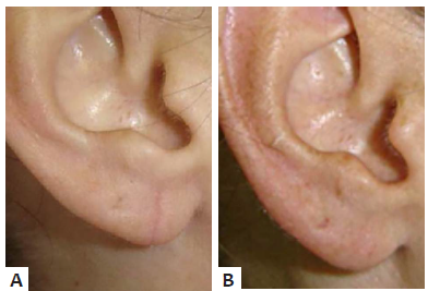 A - 15° dia de pós-operatório de correção de lóbulo
								de orelha. B - Após três meses, com uso de gel de
								silicone