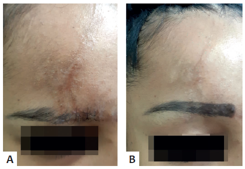 A - Paciente antes do tratamento B -
							Paciente 30 dias ap&oacute;s a &uacute;ltima sess&atilde;o