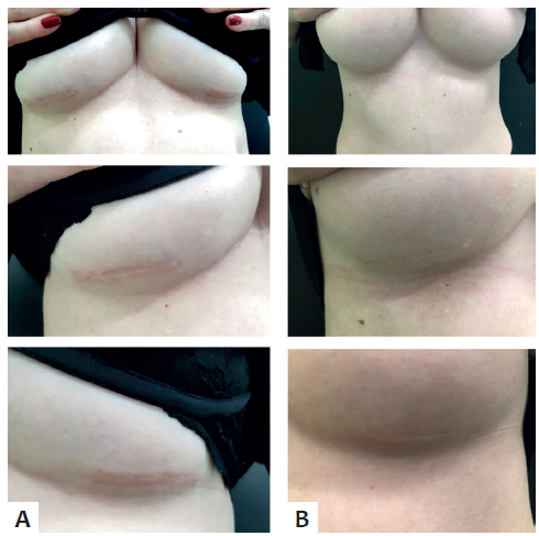 A - Paciente antes do tratamento B -
							Paciente 30 dias ap&oacute;s a &uacute;ltima sess&atilde;o