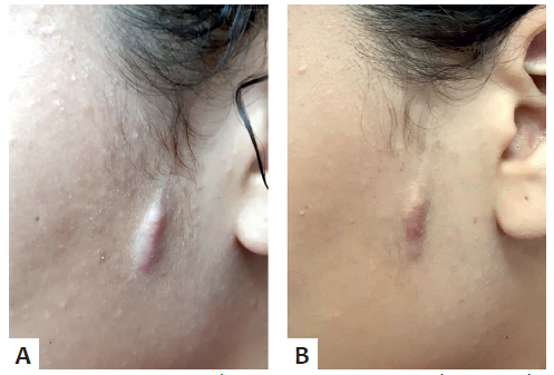 A - Paciente antes do tratamento B -
							Paciente 30 dias ap&oacute;s a &uacute;ltima sess&atilde;o