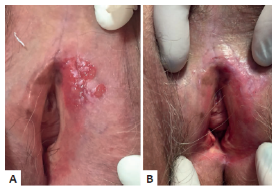 Doen&ccedil;a de Paget extramam&aacute;ria do caso 1. A -
							Pr&eacute;-tratamento, apresentando les&atilde;o em regi&atilde;o vulvar superior esquerda.
								B - Ap&oacute;s oito semanas de tratamento com imiquimode,
							apresentando melhora completa