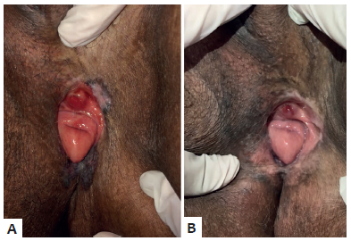 Doen&ccedil;a de Paget extramam&aacute;ria do caso 2. A -
							Pr&eacute;-tratamento, com duas les&otilde;es em regi&atilde;o vulvar, uma superior esquerda
							e outra inferior pr&oacute;xima &agrave; f&uacute;rcula. B - Ap&oacute;s oito semanas
							de imiquimode, apresentando melhora completa