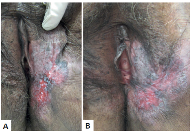 Doen&ccedil;a de Paget extramam&aacute;ria do caso 3. A -
							Pr&eacute;-tratamento, com extensa &aacute;rea de comprometimento vulvar esquerdo.
								B - Ap&oacute;s 28 semanas de imiquimode, sem resposta ao
							tratamento