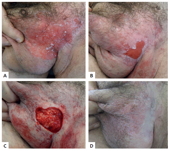 Doen&ccedil;a de Paget extramam&aacute;ria do caso 4. A -
							Pr&eacute;-tratamento com uma les&atilde;o em regi&atilde;o de bolsa escrotal extensa.
								B - Ap&oacute;s oito semanas de tratamento com imiquimode,
							apresentando melhora parcial, com regress&atilde;o da &aacute;rea de acometimento da
							les&atilde;o. C - Ap&oacute;s abordagem de ex&eacute;rese cir&uacute;rgica.
								D - Seguimento de dois meses, sem recidiva at&eacute;
							ent&atilde;o