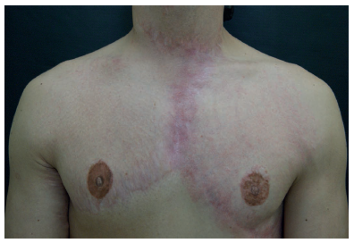 Paciente com estrias distensas e cicatrizes hipertr&oacute;ficas perif&eacute;ricas
							na &aacute;rea do enxerto cut&acirc;neo