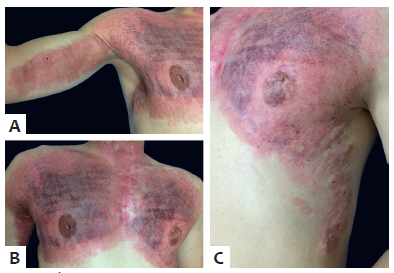 &Aacute;rea do t&oacute;rax imediatamente ap&oacute;s o microagulhamento: eritema difuso e
							pet&eacute;quias podem ser observados (pain&eacute;is A, B e C)