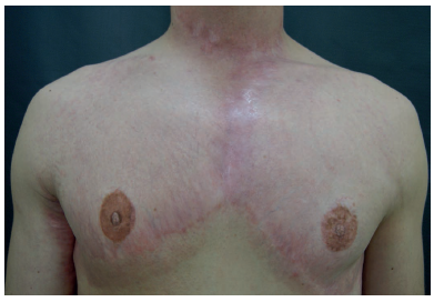 Seis meses ap&oacute;s o &uacute;ltimo procedimento: melhora nas cicatrizes
							hipertr&oacute;ficas, nas estrias e na qualidade global da pele