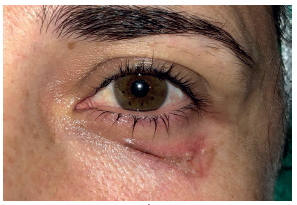 Carcinoma basocelular na pálpebra inferior