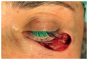 Defeito após a remoção do carcinoma basocelular, envolvendo grande
							extensão da lamela anterior da pálpebra inferior