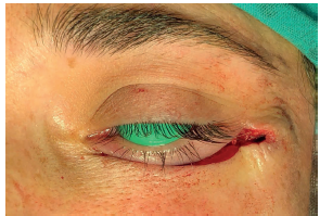 Aproximação da ferida após a elevação da fáscia
										suborbicular dos olhos