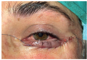 Resultado no pós-operatório imediato