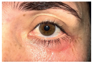 Resultado final um mês após a cirurgia