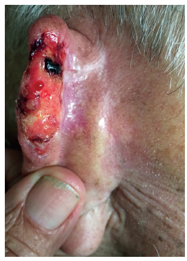 Les&atilde;o ulcerada na h&eacute;lice e regi&atilde;o posterior da orelha
							esquerda