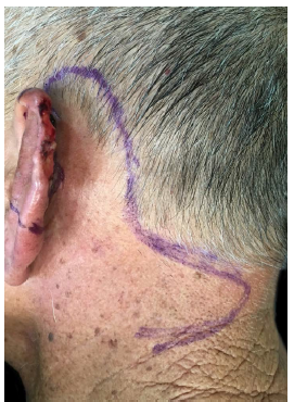 Demarca&ccedil;&atilde;o da incis&atilde;o para ressec&ccedil;&atilde;o da les&atilde;o na h&eacute;lice e regi&atilde;o
							posterior da orelha, e configura&ccedil;&atilde;o dos dois retalhos romboidais na
							regi&atilde;o retroauricular e occipital