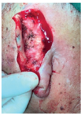 Resse&ccedil;&atilde;o completa da les&atilde;o neopl&aacute;sica