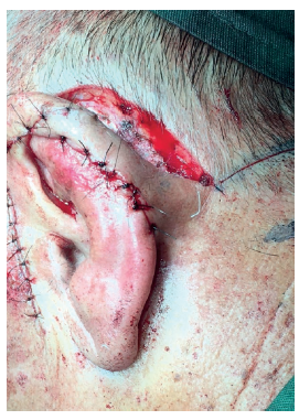 O retalho retangular proveniente da regi&atilde;o pr&eacute;-auricular foi
							utilizado para reconstruir a parte superior da h&eacute;lice, enquanto o
							retalho romboidal da regi&atilde;o retroauricular foi transposto para cobrir a
							regi&atilde;o inferior da h&eacute;lice e posterior da orelha