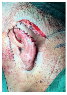 Incis&atilde;o do retalho romboidal na regi&atilde;o occipital