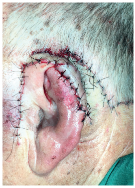 Resultado ap&oacute;s transposi&ccedil;&atilde;o do retalho da regi&atilde;o occipital para a
							retroauricular, com sutura da ferida gerada na regi&atilde;o occipital,
							configurando dessa forma a terceira transposi&ccedil;&atilde;o realizada na
							reconstru&ccedil;&atilde;o da orelha
