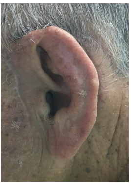 P&oacute;soperat&oacute;rio tardio da reconstru&ccedil;&atilde;o da orelha pela t&eacute;cnica de
							retalho com transposi&ccedil;&atilde;o tripla