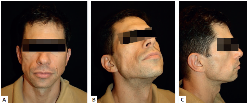 Paciente apresentando atrofia leve da regi&atilde;o malar direita, com
							preju&iacute;zo est&eacute;tico