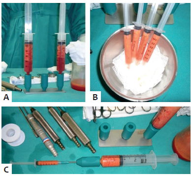 Aspectos do transoperat&oacute;rio. Prepara&ccedil;&atilde;o do conte&uacute;do a ser
							enxertado
