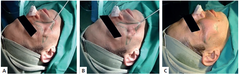 Aspectos do transoperat&oacute;rio. Lipofilling na hemiface
							acometida
