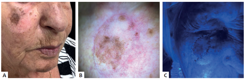 A - Caracter&iacute;sticas cl&iacute;nicas do lentigo maligno.
								B - Dermatoscopia. C - Exame com l&acirc;mpada
							de Wood